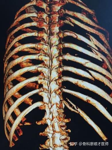 胸骨骨折症状图片