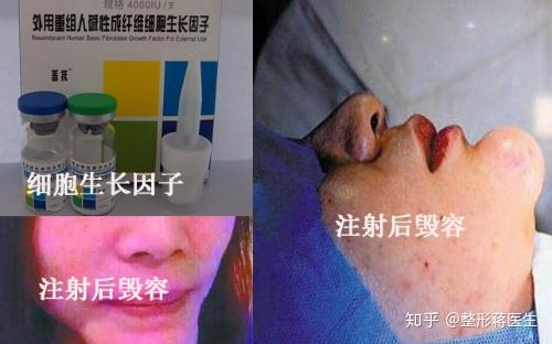 人工骨粉:主要是指羟基磷灰石,该材料注射于鼻部很难塑形,成形后也