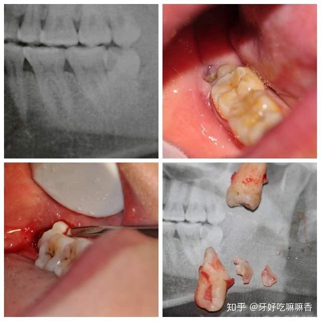 不過因為有一些智齒是長歪的,橫