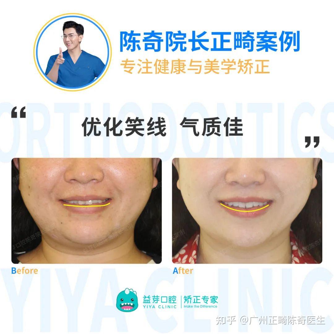 【正畸美学】揭秘“笑线”给笑容带来的变化！一起解锁自信笑容 - 知乎