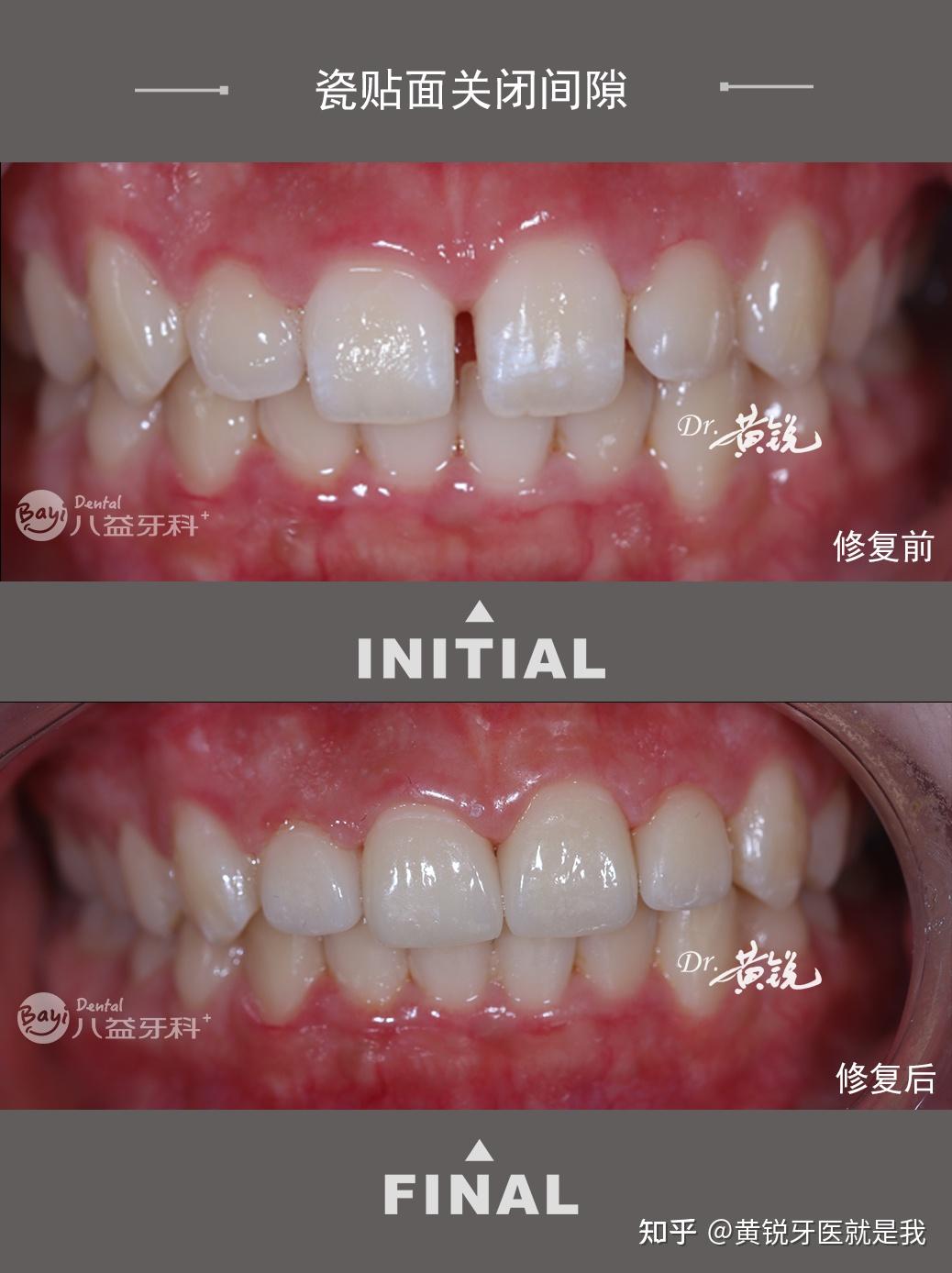 分享|瓷贴面关闭间隙 - 知乎