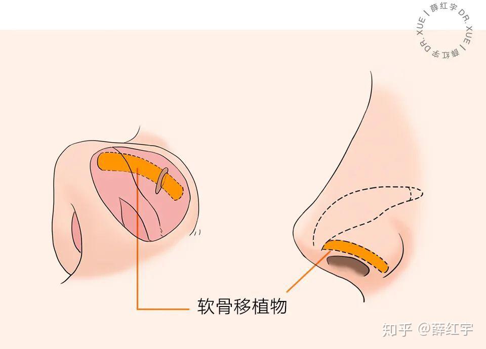 露鼻孔(鼻孔外露,鼻翼缘退缩)怎么办?