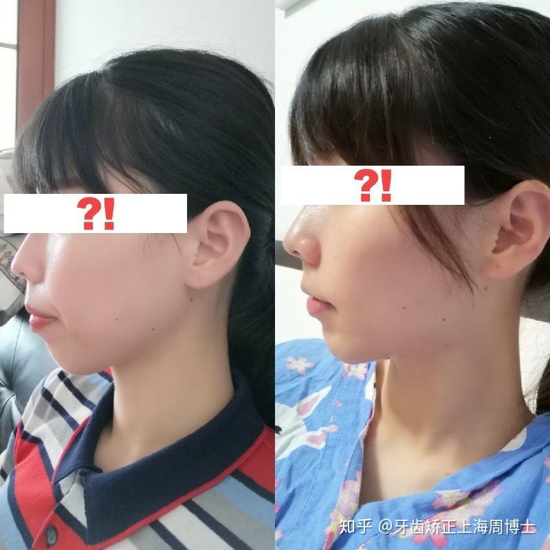 下巴后缩想打针?不如先看矫正医生!