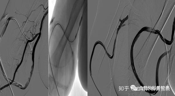 「名医访谈」系列之——血管通路常见问题解答 - 知乎