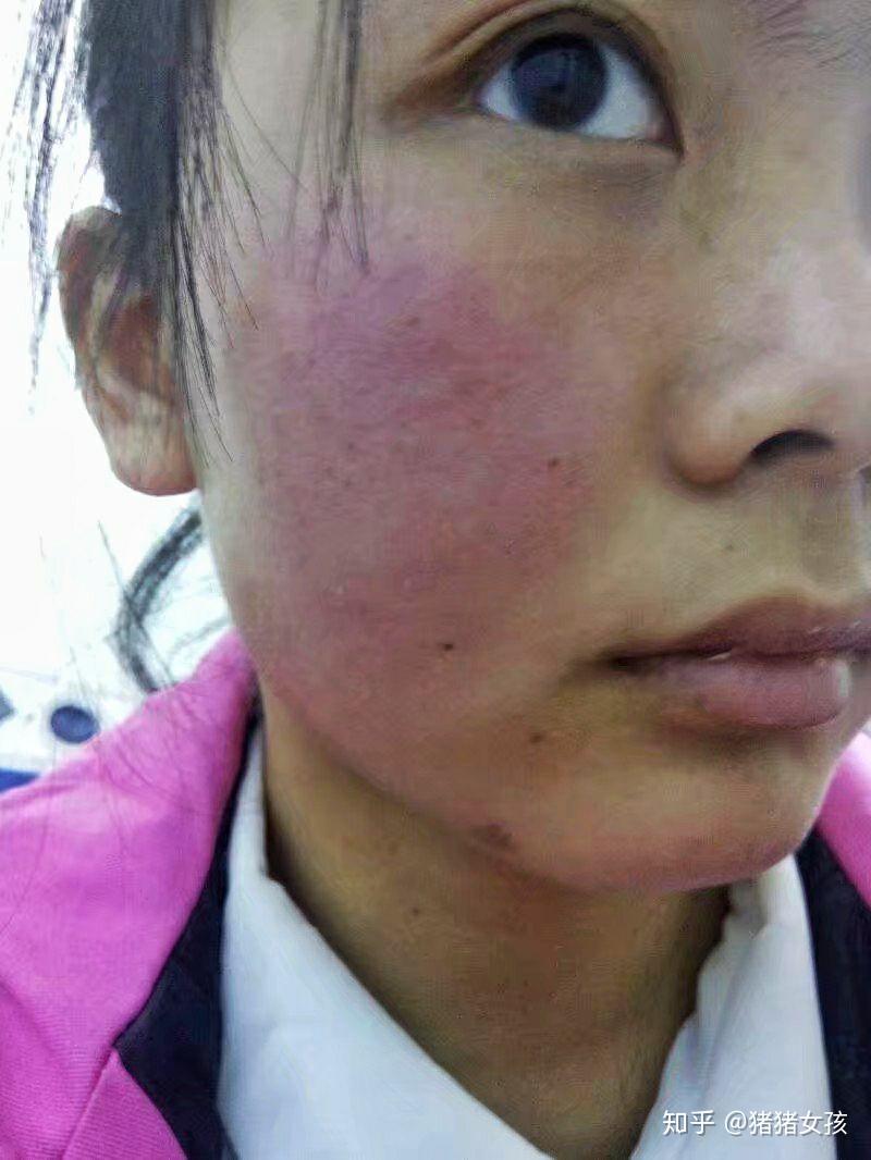 红血丝激素脸我都经历过了