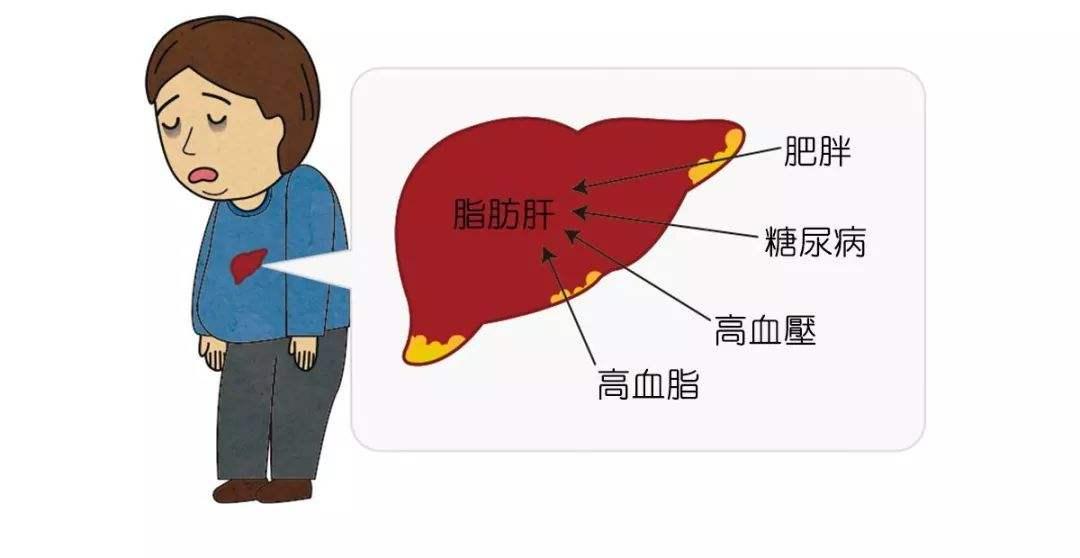 脂肪肝和酒精肝有什麼不同醫生幫你區分