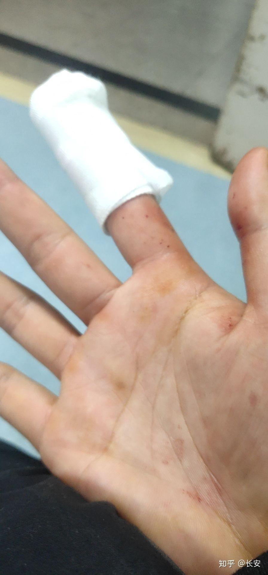 手指头被夹伤后你是什么样的感受怎么处理的