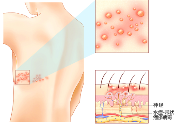 带状疱疹怎么治好的