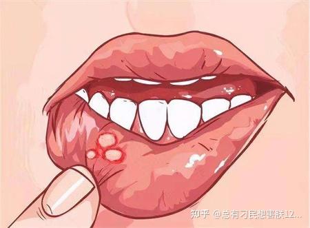 口腔白斑是什么样子图片