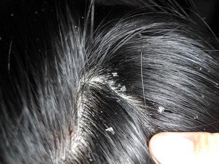 芳香疗法 配方篇 精油护理头发体验 油头发 头痒 头屑 脂溢性皮炎看过来 知乎 芳香疗法 配方篇 精油护理头发体验 油头发 头痒 头屑 脂溢性皮炎看过来 知乎