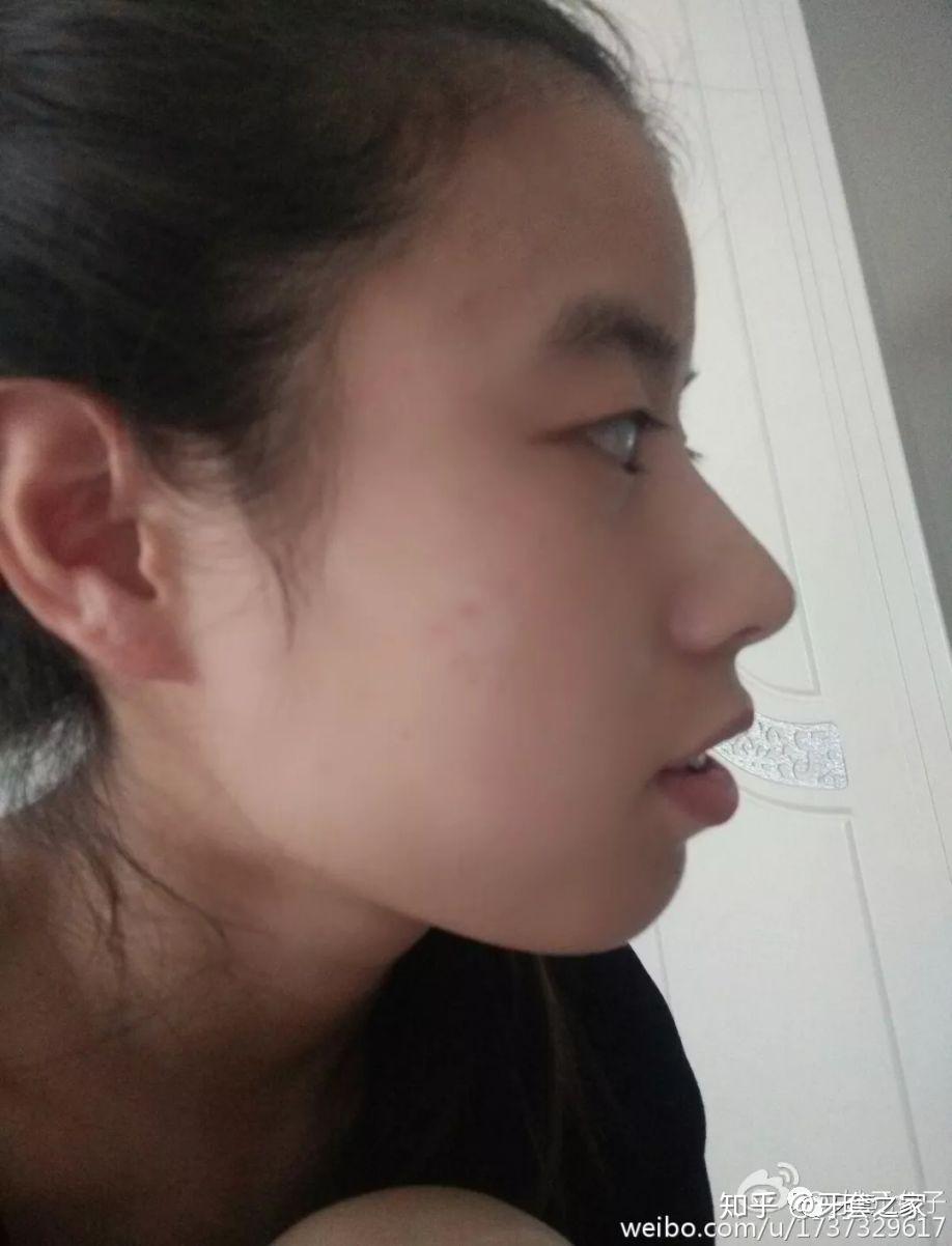 牙齿前凸龅牙矫正过程遇到庸医中途转诊