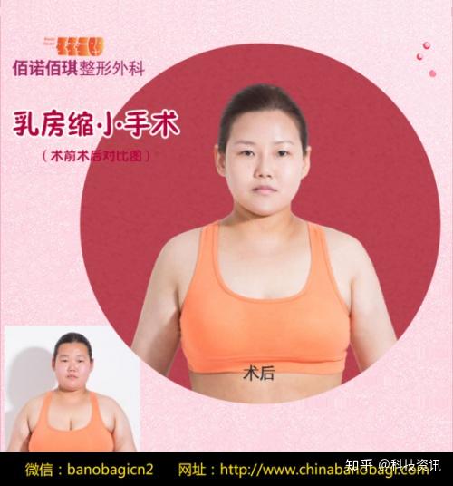 佰诺佰琪韩国乳房缩小手术该不该做