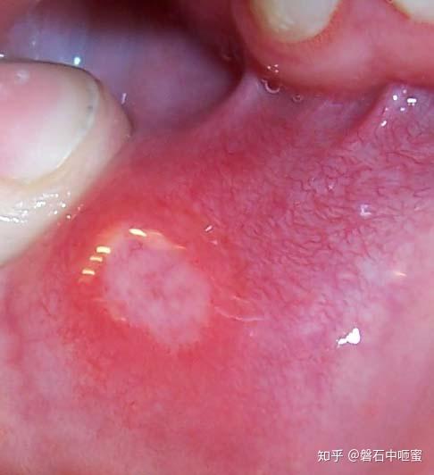 口腔瘘管的症状图片图片