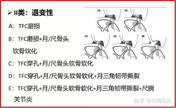 x線,ct:可以觀察骨性結構有無出現變異情況,月骨和尺骨頭是否有影像學