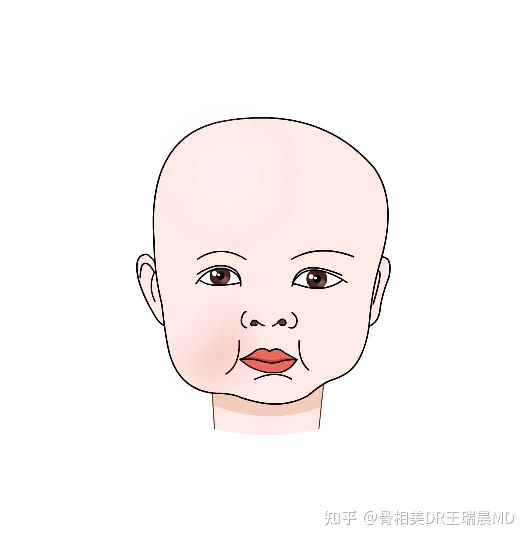 大小脸嘴歪应该看什么科