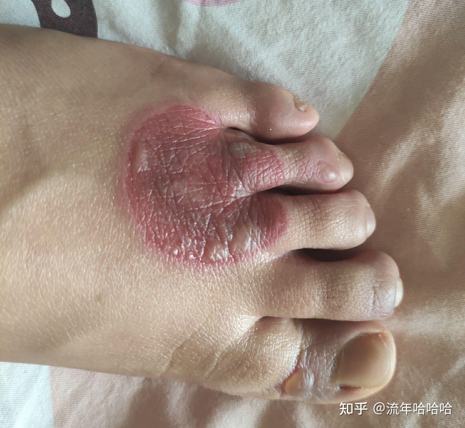 得了白塞病的我真的很绝望