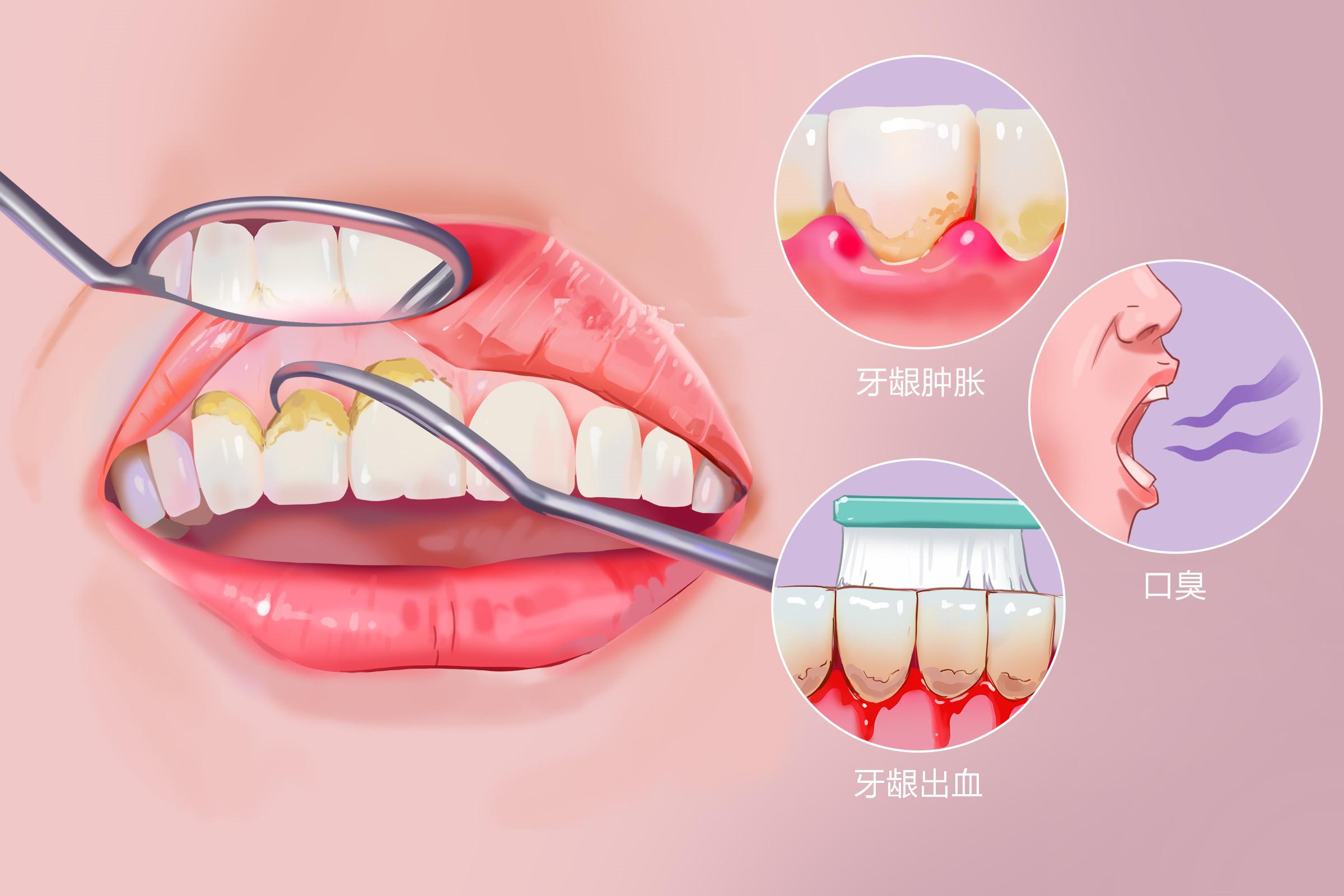 牙结石是怎么形成的？97%的人患有牙结石，轻松方法能防治_牙齿