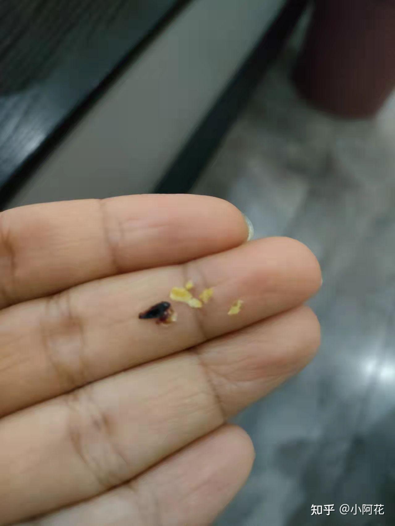 3岁女宝耳朵的耳屎堵住怎样清理? - 知乎