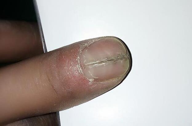 指甲开裂是怎么回事?