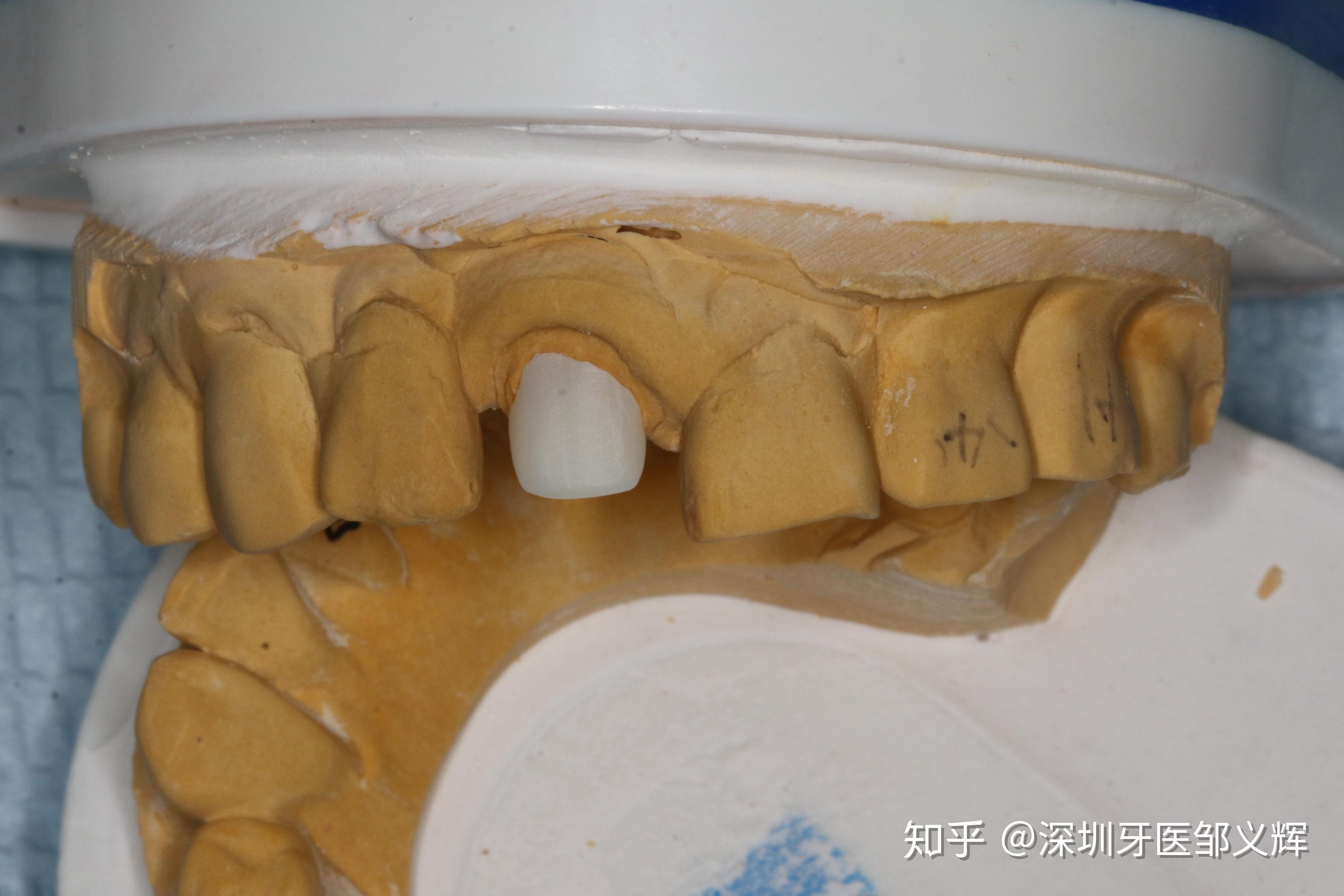 前牙折断氧化锆桩全瓷冠修复一例