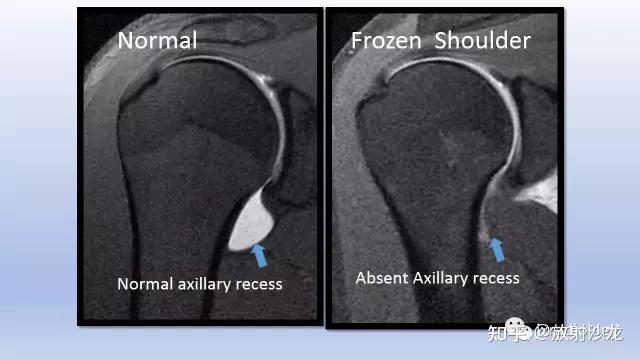 axillary artery图片