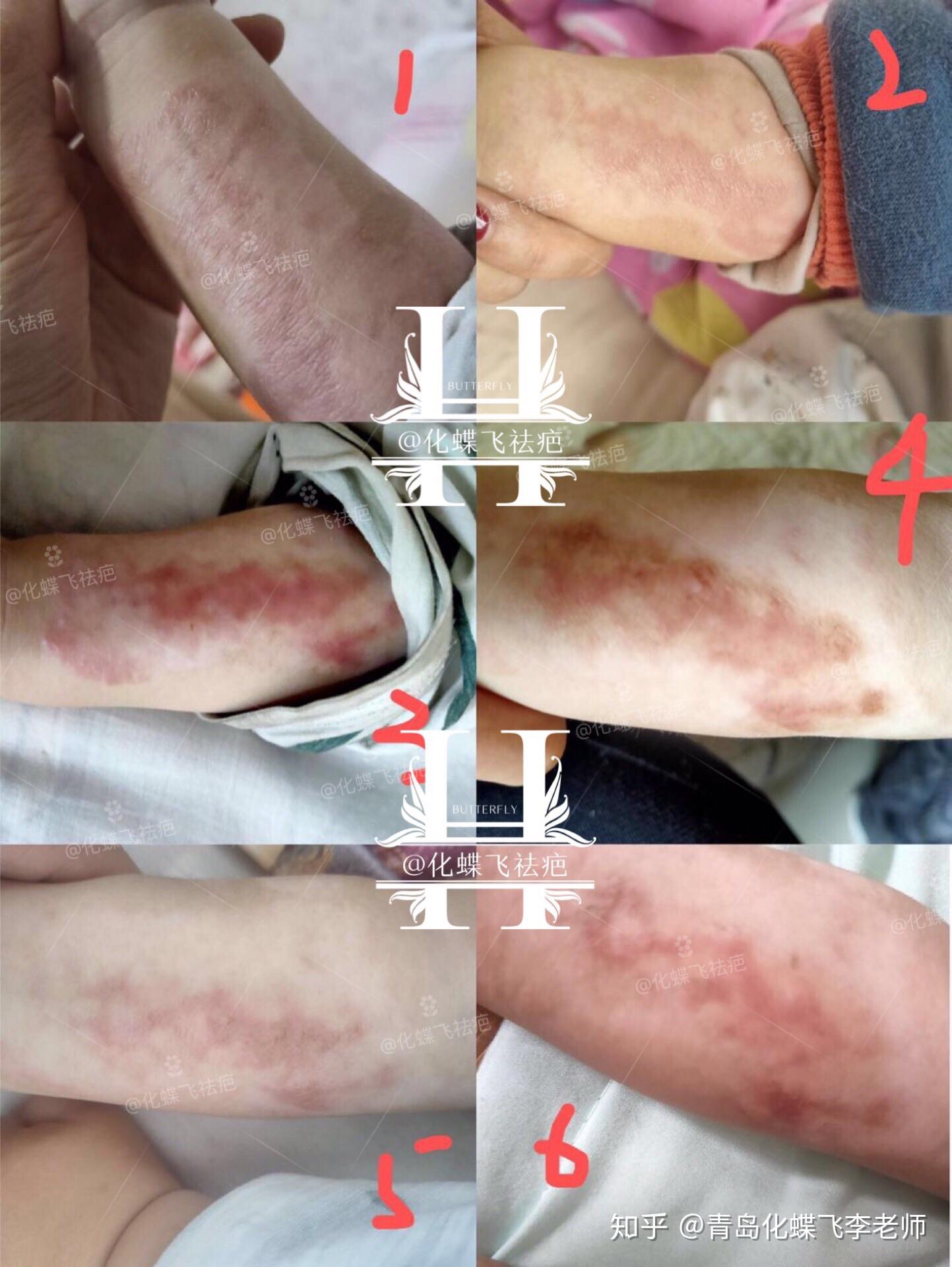 宝宝烫伤萎缩并增生疤痕修复对比