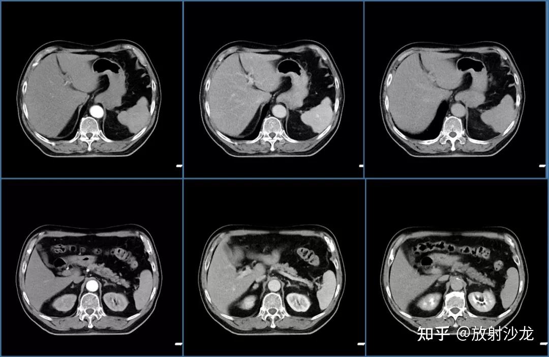 这样的充盈缺损是肺栓塞? - 知乎