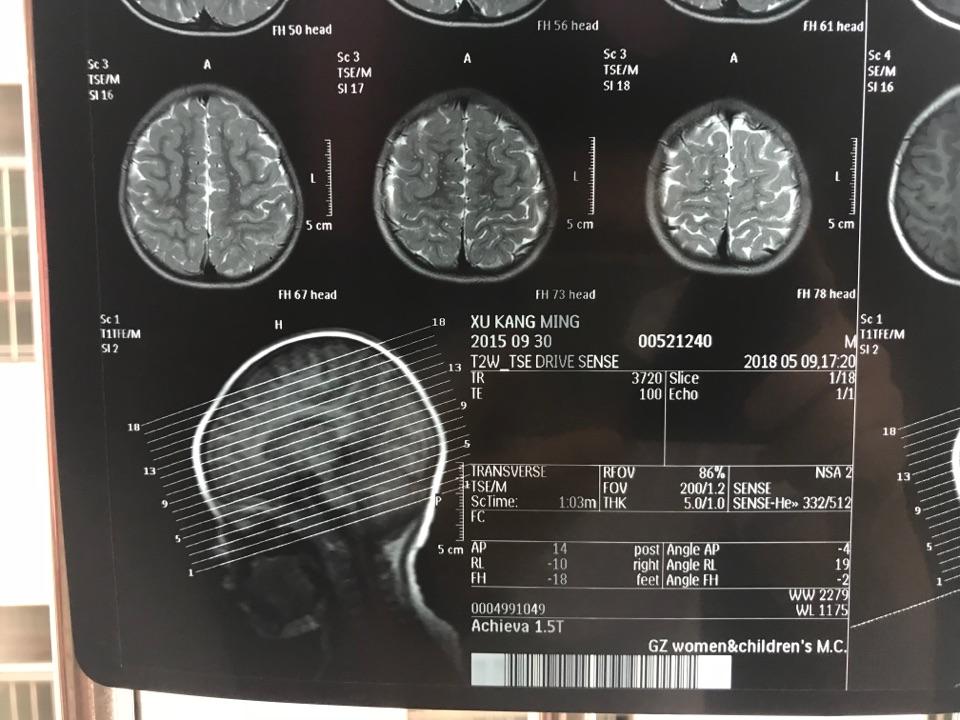 磁共振,双侧半卵圆中心及侧脑室后角旁白质异常信号,考虑扩大的血管