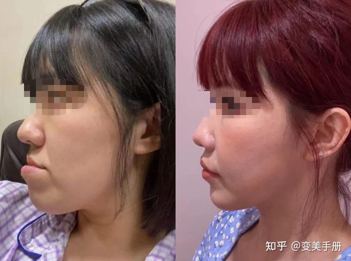 嘴凸怎么改善正畸vs正颌哪种方式更适合你怎么选择靠谱的正颌医生