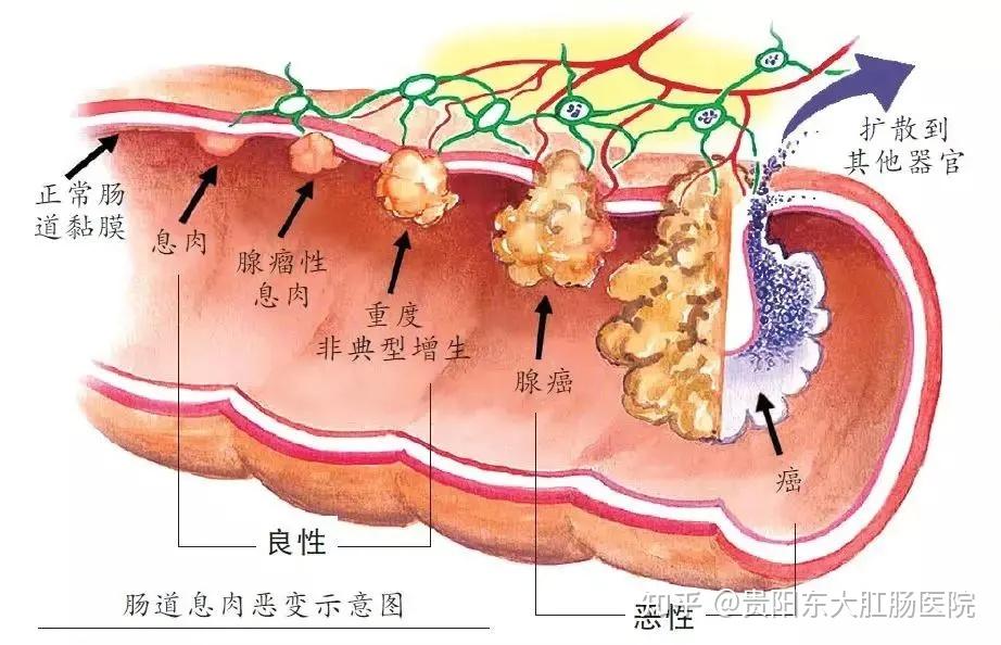 切除息肉后应该多久复查一次?