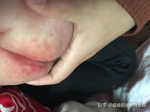 女宝宝尿道两侧红湿疹图片