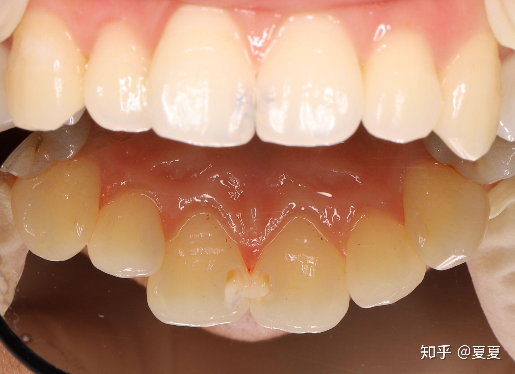 门牙缝大+先天性前牙缺失矫正案例
