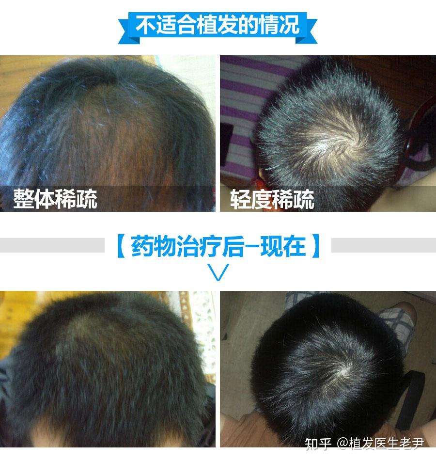为什么雄脱不适合植发(雄性脱发为什么只脱头顶)