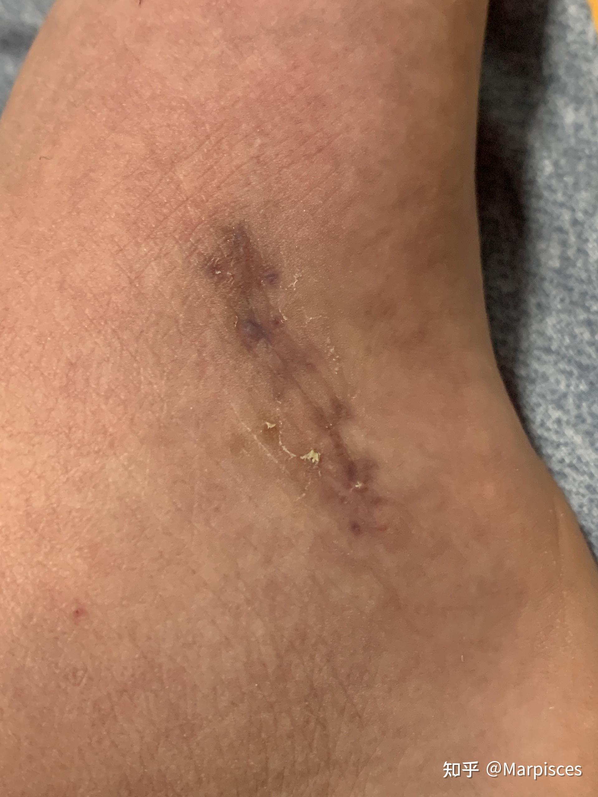 切除副舟骨记录