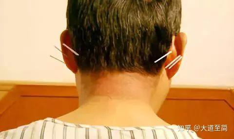 国医大师石学敏院士醒脑开窍针刺法的组成与操作(最全收藏) - 知乎