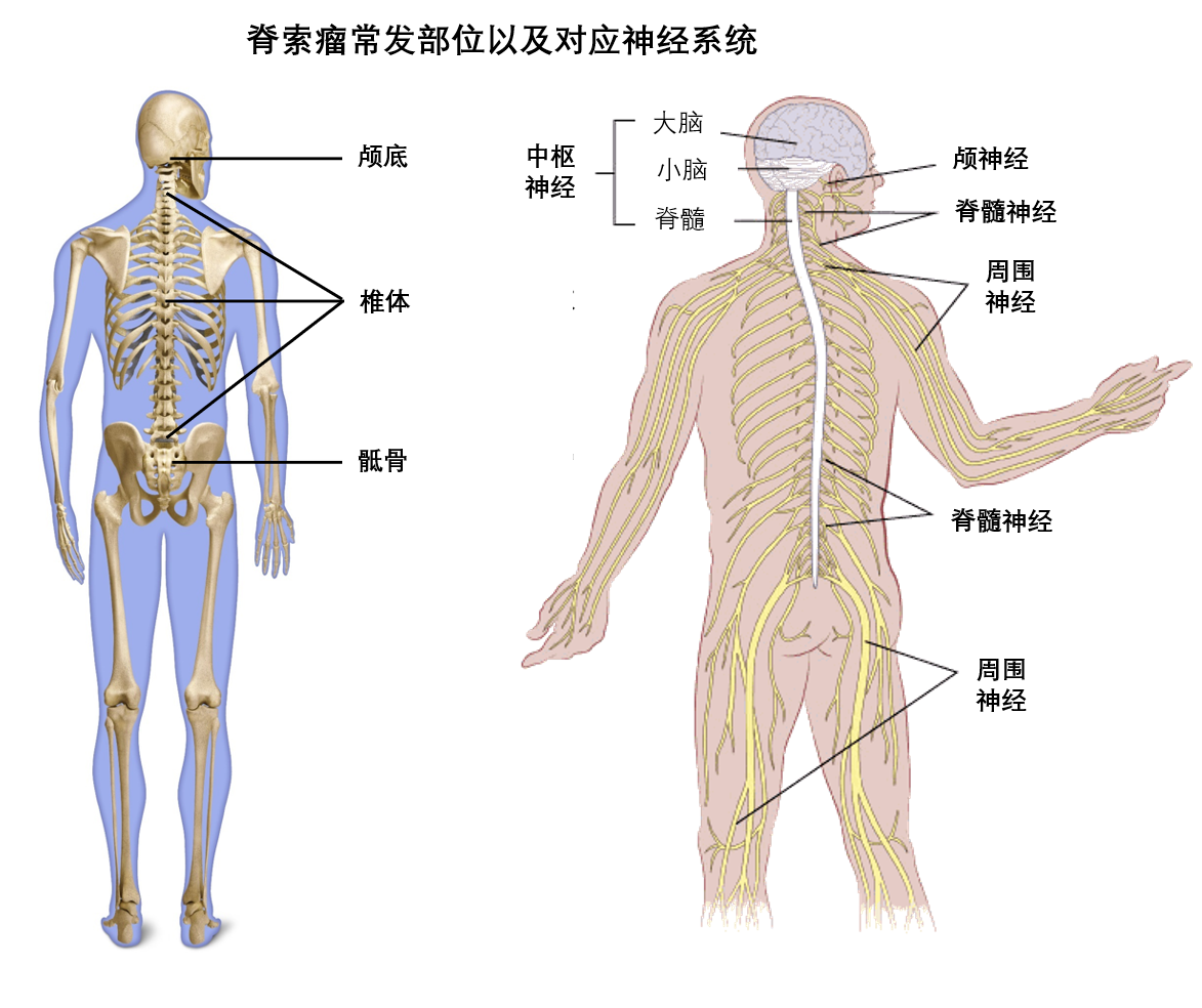 一文读懂脊索瘤的症状 诊断 分期和治疗 上 知乎