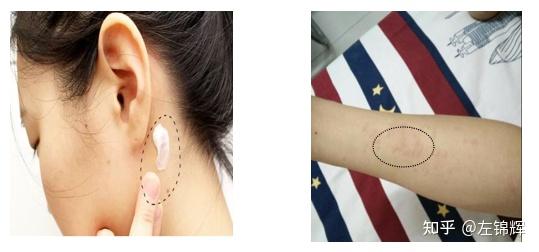 用防晒霜就过敏但是也不能完全不出门怎么办