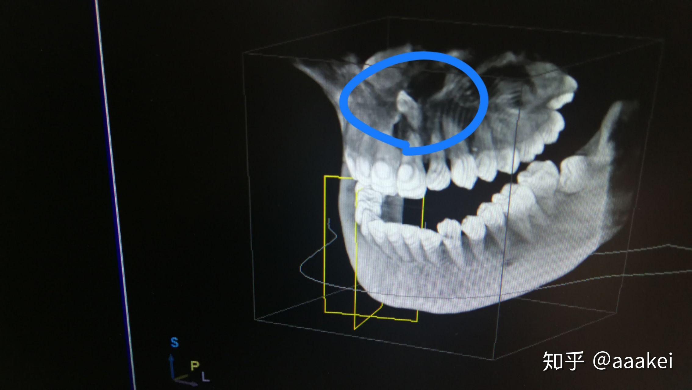 多生齿,女朋友矫正牙齿后拍片偶然发现上颚与鼻腔之间有一颗多生齿