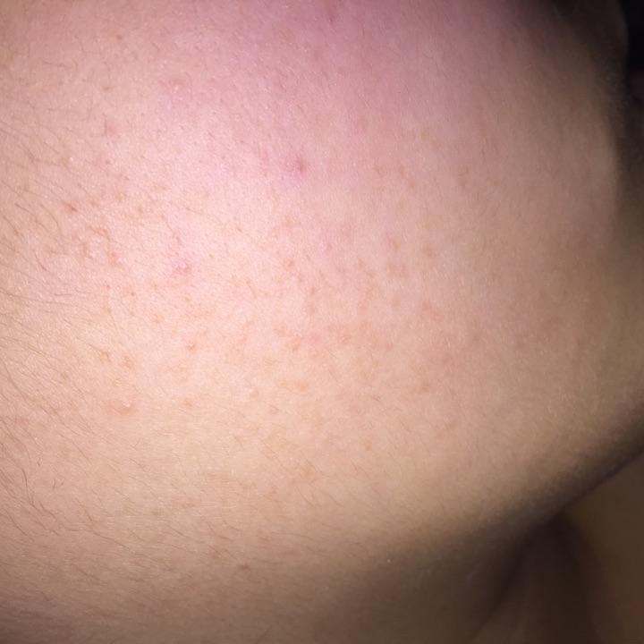 脸上突然起了密密麻麻的东西像鸡皮疙瘩似的有些痒肉眼看不见一摸能摸