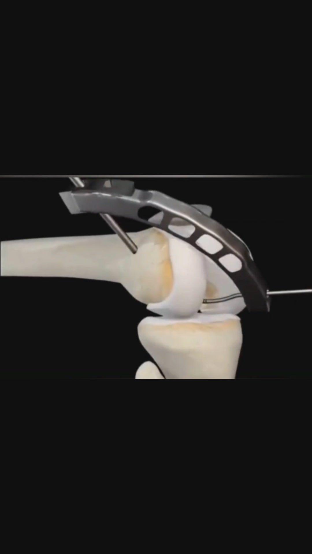 半月板損傷修復視頻–3d動畫