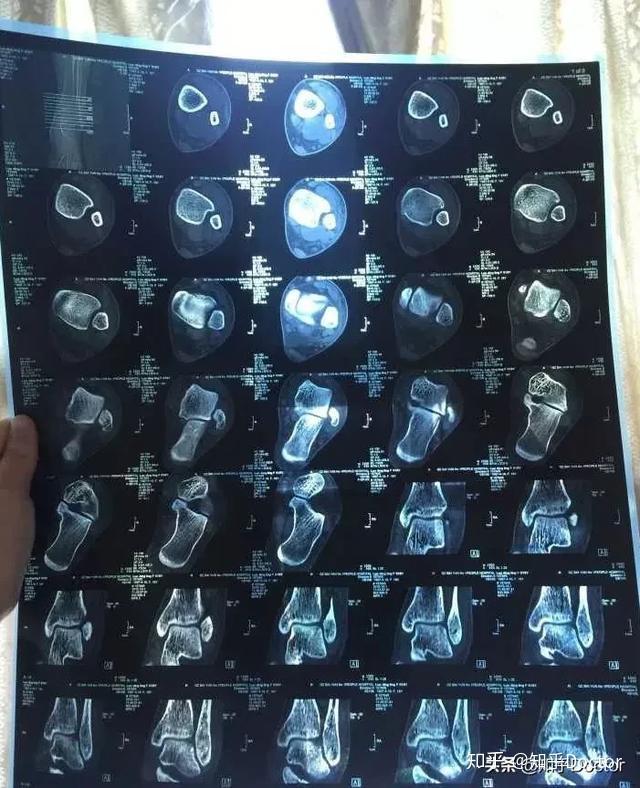 骨折拍了x線為什麼還要做ct和mri