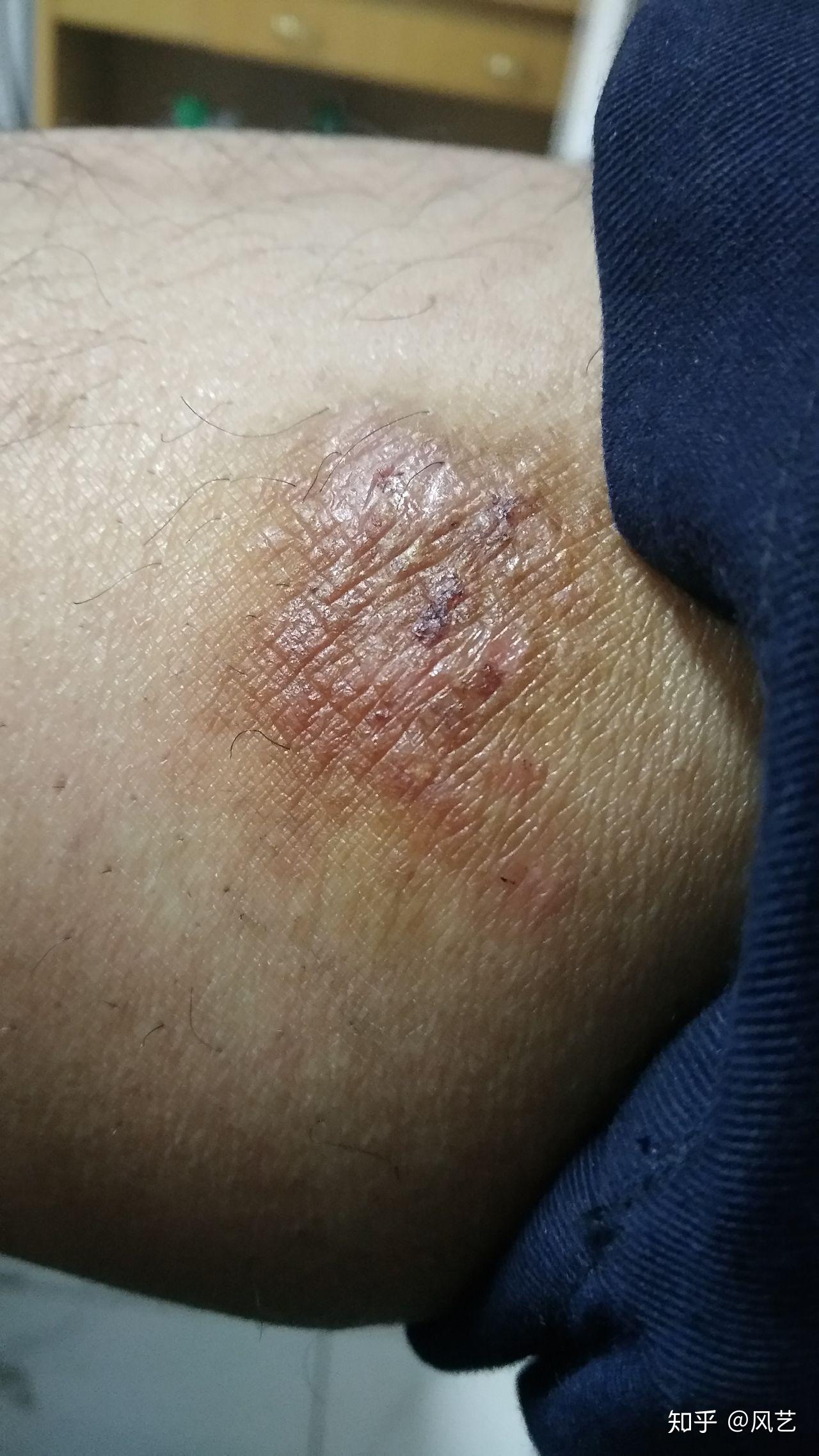 久病成医治好了自己的神经性皮炎