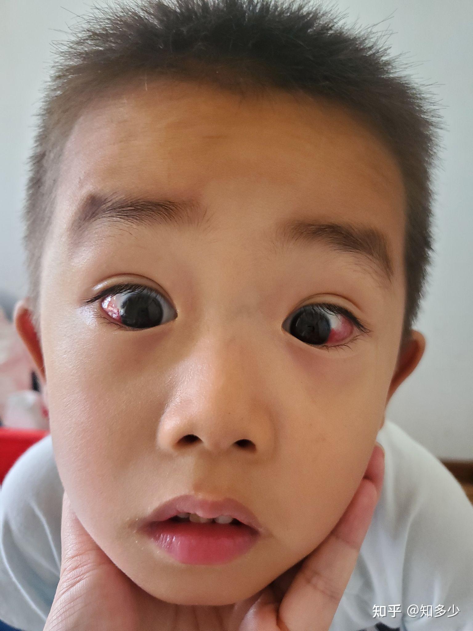 【普瑞眼科·点亮明眸】5名孩子接受斜视手术_麦迪娜依·艾尼