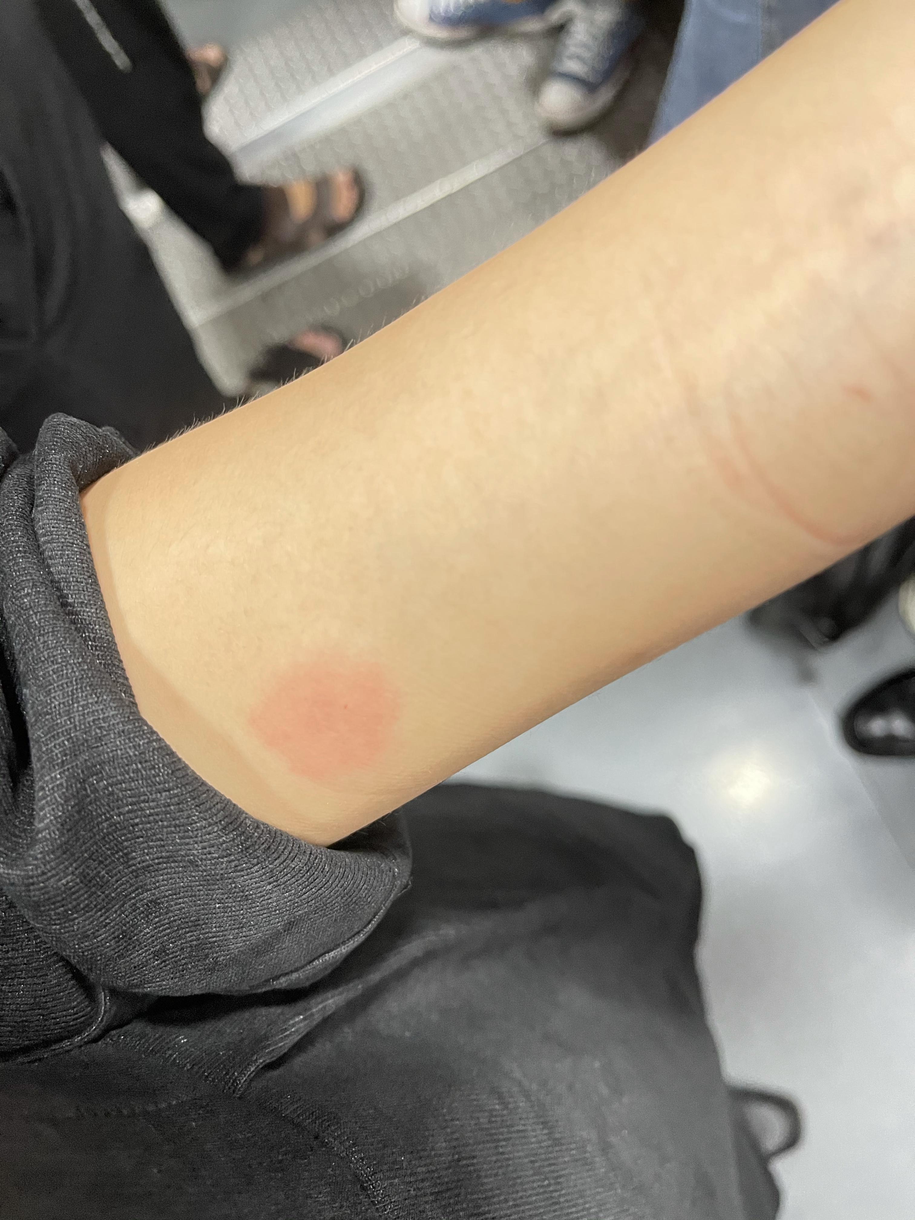 结核皮试起了个大水泡,破了怎么办? - 知乎
