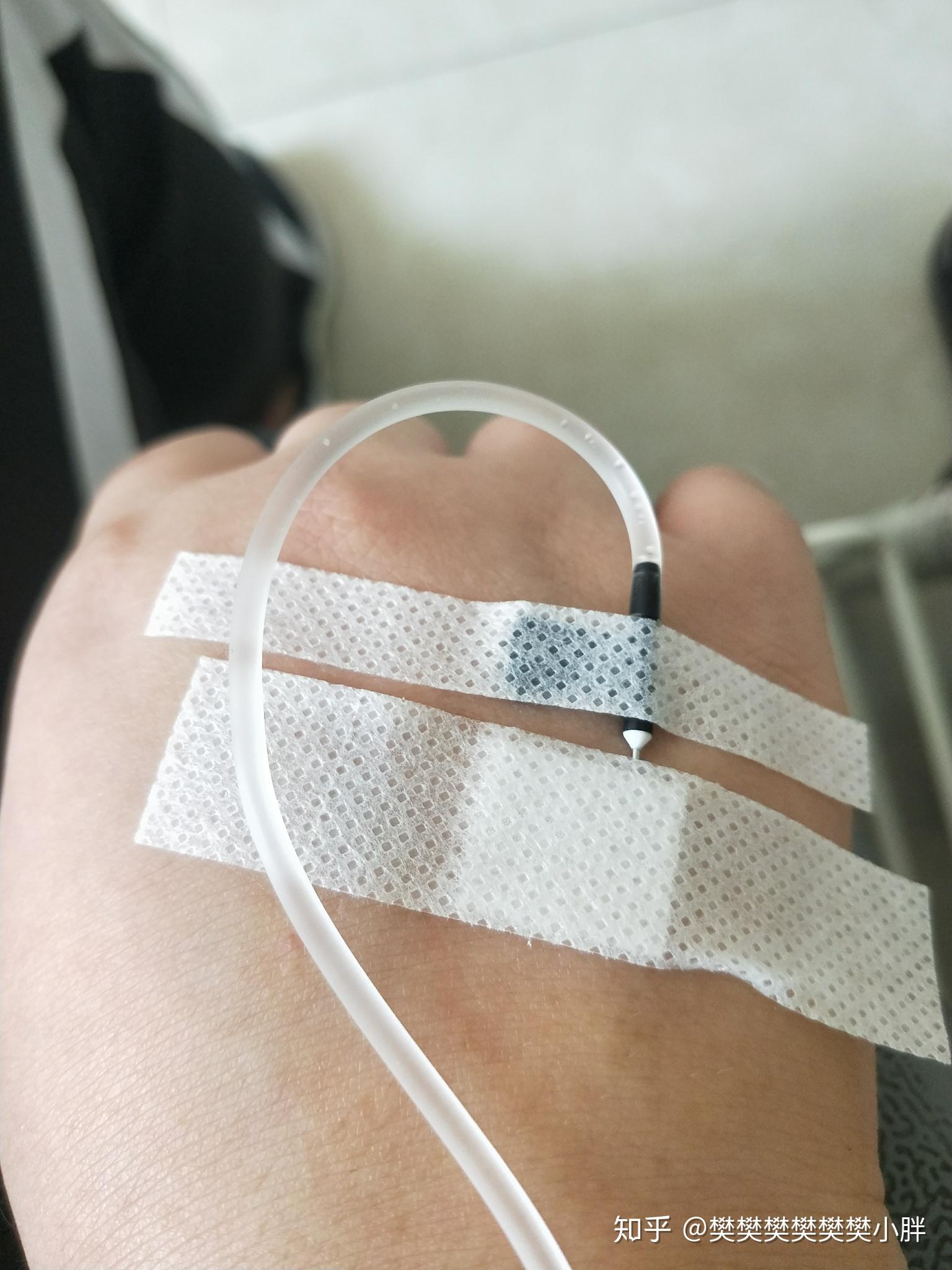 阑尾挂水可以吃东西吗? - 知乎