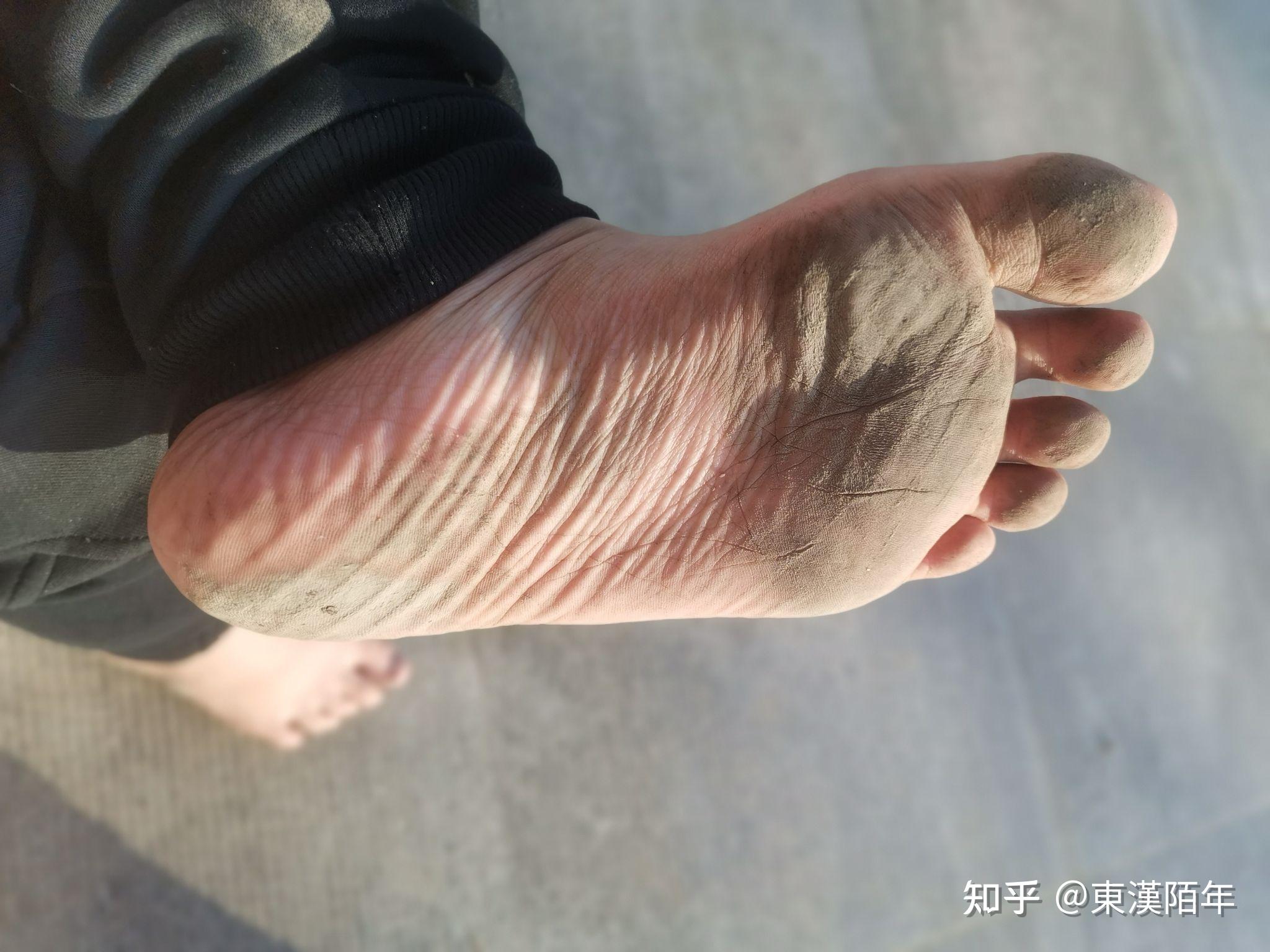 长期赤脚生活的脚底是什么样子的?