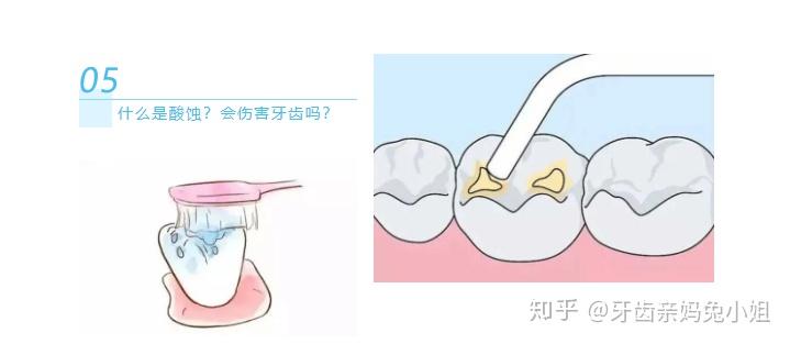 窩溝封閉咋回事?看完你就知道了! - 知乎