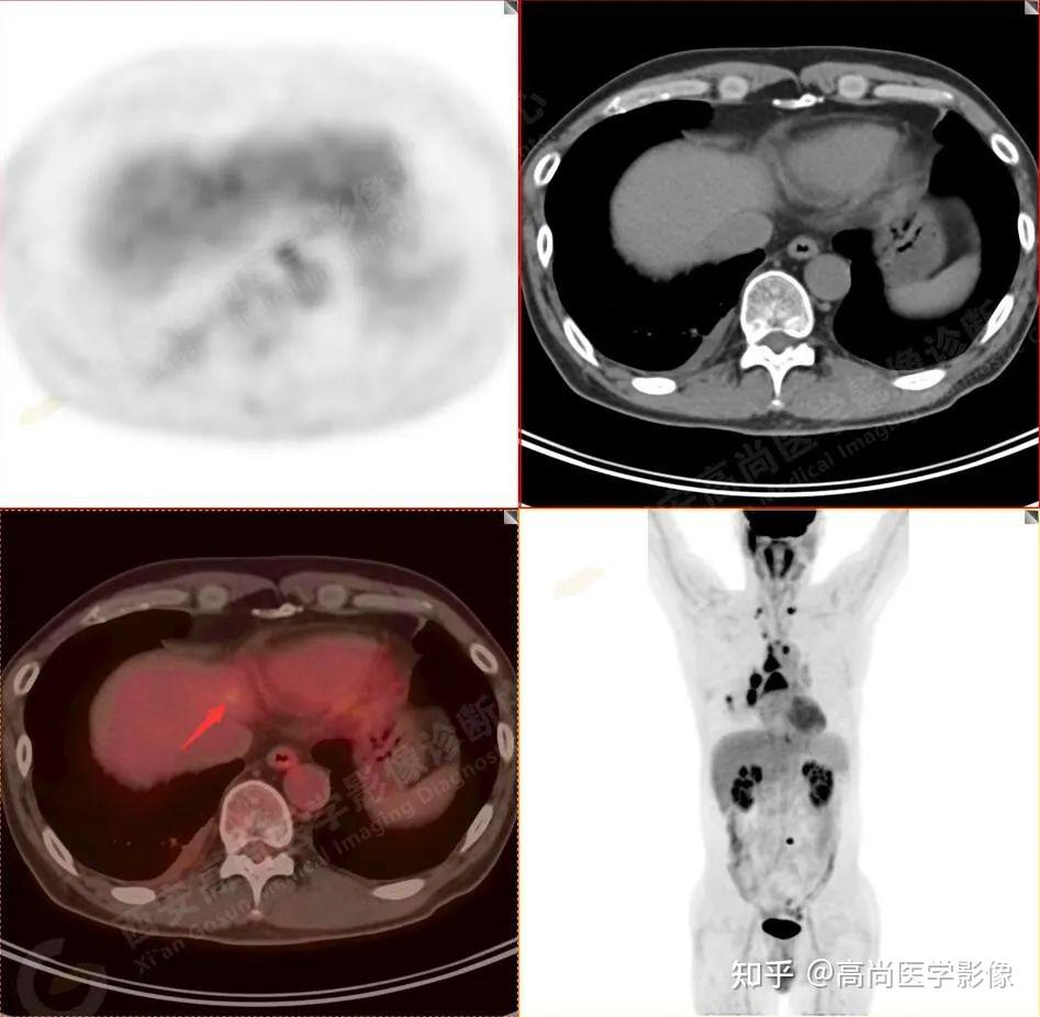 PET/CT肿瘤分期：低分化肺腺癌，小结节大转移两例【高尚医学影像】 - 知乎