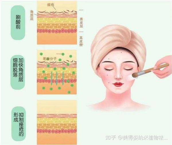 正确认识刷酸的概念及术后护理! - 知乎