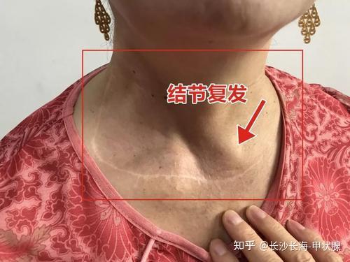 甲状腺结节不治疗会怎么样会有危险吗
